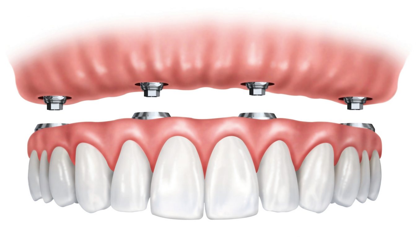 Dental Implant Dentures 