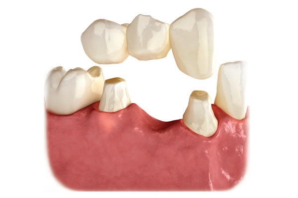 Healthy teeth are ground down to make a Dental Bridge. Tooth preparation for Bridges may lead to more cavities and failure of the supporting teeth