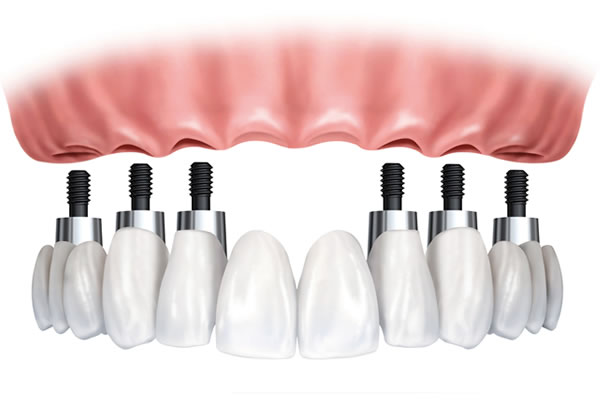 Dental Implant Bridges 