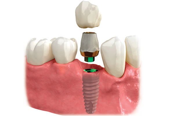 Single Dental Implants 