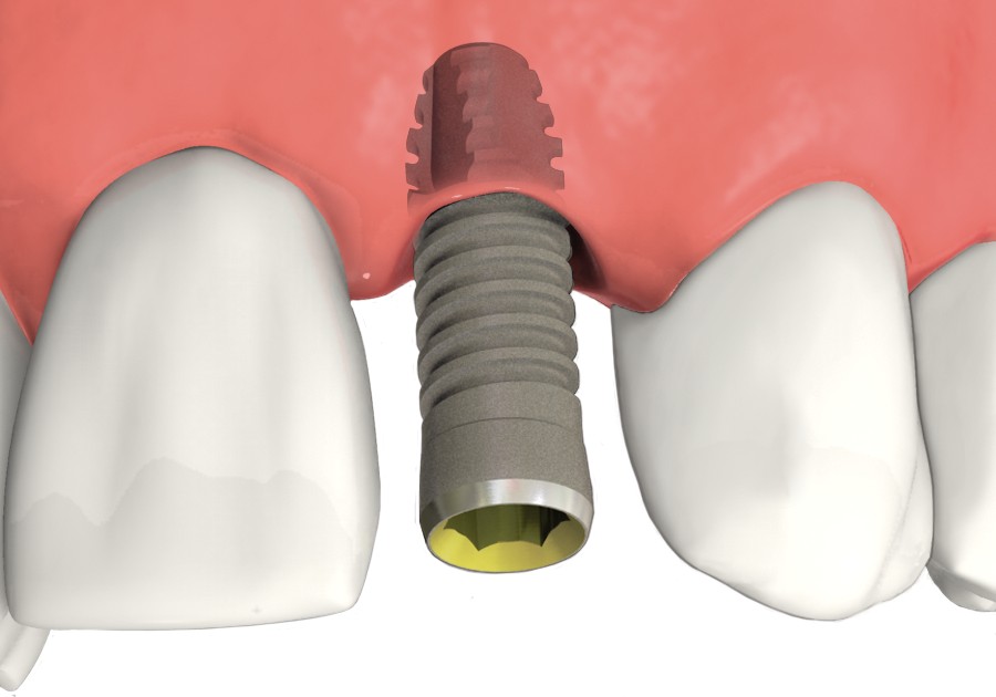 Dental implant is placed in the bone beneath the gum