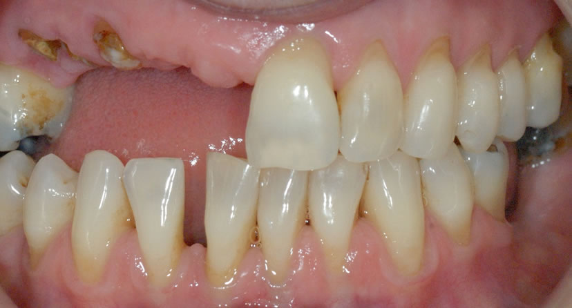 Before Dental Implants Somerset
